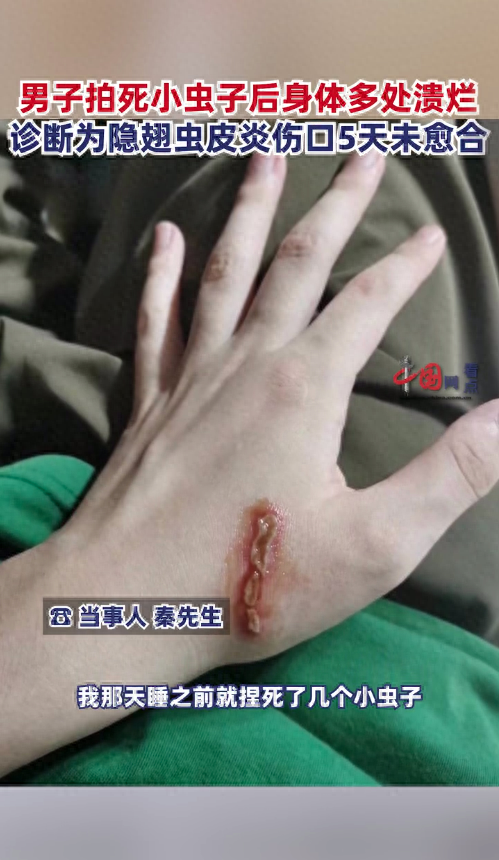 家里出现隐翅虫怎么消灭(宝鸡一男子拍死隐翅虫,致身上多处溃烂肿痛,遇到隐翅虫怎么办)(图1) 家里出现隐翅虫怎么消灭(宝鸡一男子拍死隐翅虫,致身上多处溃烂肿痛,遇到隐翅虫怎么办)(图1)