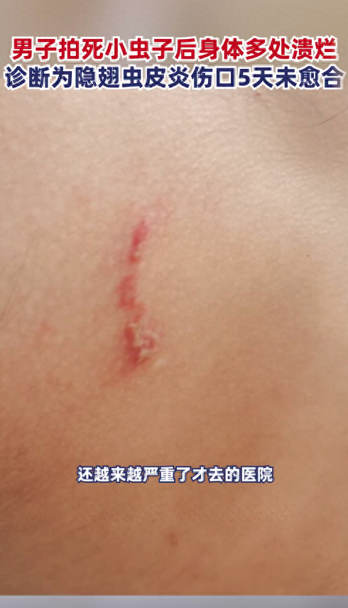 家里出现隐翅虫怎么消灭(宝鸡一男子拍死隐翅虫,致身上多处溃烂肿痛,遇到隐翅虫怎么办)(图2) 家里出现隐翅虫怎么消灭(宝鸡一男子拍死隐翅虫,致身上多处溃烂肿痛,遇到隐翅虫怎么办)(图2)