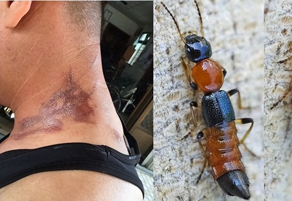 家里出现隐翅虫怎么消灭(宝鸡一男子拍死隐翅虫,致身上多处溃烂肿痛,遇到隐翅虫怎么办)(图5) 家里出现隐翅虫怎么消灭(宝鸡一男子拍死隐翅虫,致身上多处溃烂肿痛,遇到隐翅虫怎么办)(图5)