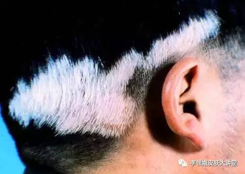 白点癫风是什么原因引起的(「白癜风」白癜风及其鉴别)(图3) 白点癫风是什么原因引起的(「白癜风」白癜风及其鉴别)(图3)