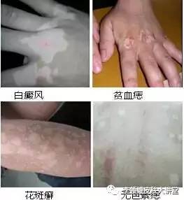 白点癫风是什么原因引起的(「白癜风」白癜风及其鉴别)(图5) 白点癫风是什么原因引起的(「白癜风」白癜风及其鉴别)(图5)