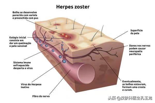 八种疱疹的图片(皮肤科常见疾病系列:疼痛难忍的带状疱疹)(图2) 八种疱疹的图片(皮肤科常见疾病系列:疼痛难忍的带状疱疹)(图2)