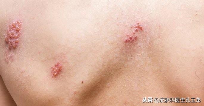 八种疱疹的图片(皮肤科常见疾病系列:疼痛难忍的带状疱疹)(图4) 八种疱疹的图片(皮肤科常见疾病系列:疼痛难忍的带状疱疹)(图4)
