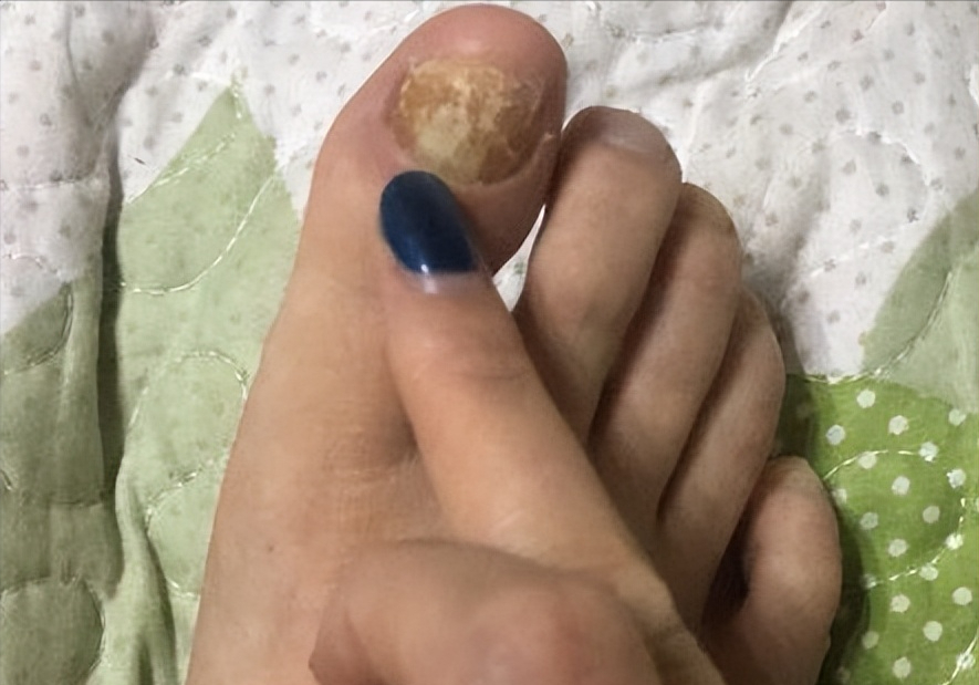 亮甲治疗灰指甲效果怎么样(卫生部对各类灰指甲药的检测结果出来了!数万人用的它竟然不合格)(图2) 亮甲治疗灰指甲效果怎么样(卫生部对各类灰指甲药的检测结果出来了!数万人用的它竟然不合格)(图2)